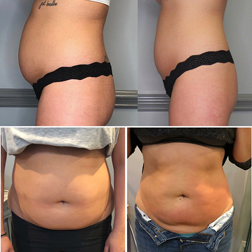 Nonsurgical Body Sculpting & Skin Tightening NO Surgery NO Downtime