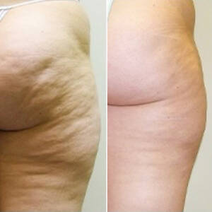 Adore Skin Studio - Cellulite Treatment