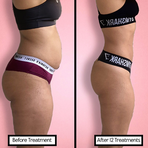 Cosmetic Devices That Offer a Non-Surgical Tummy Tuck