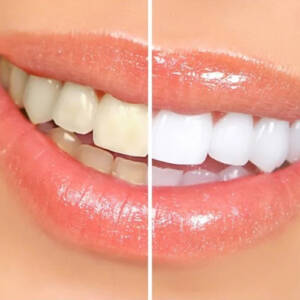 Adore Skin Studio - Teeth Whitening